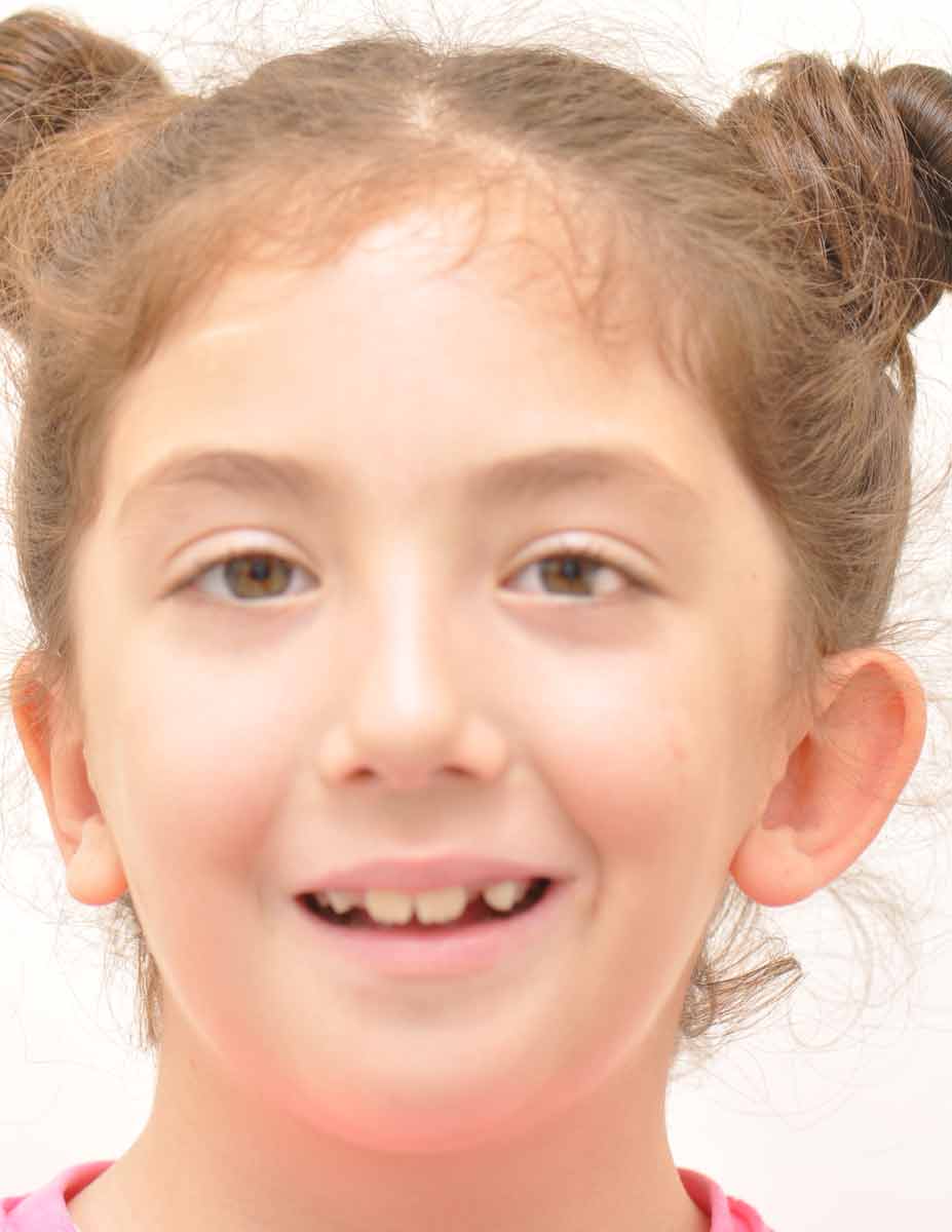 Goldenhar Syndrome Hellenic Craniofacial Center