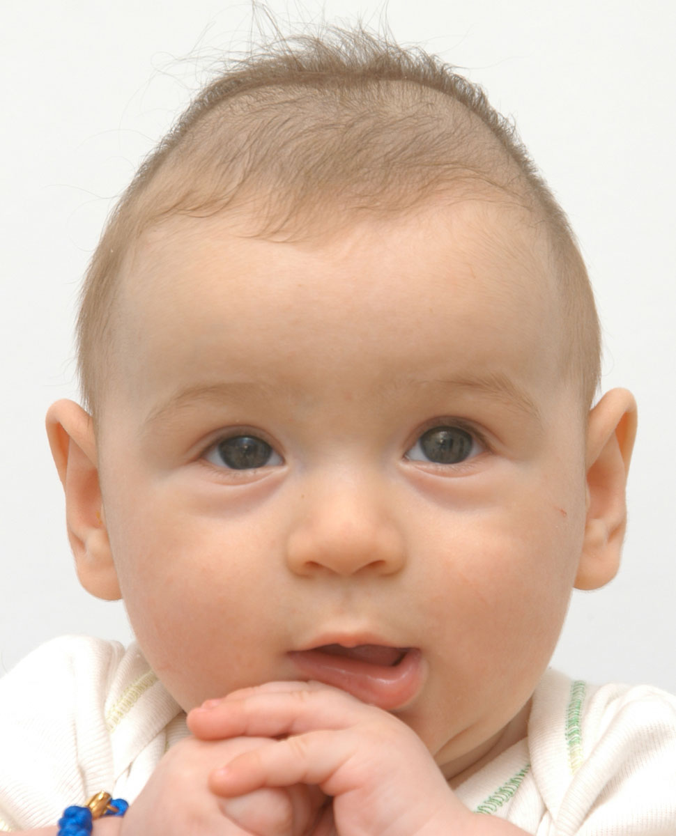 У ребенка выпирает лоб. Краниостеноз тригоноцефалия. Краниосиностоз краниостеноз. Краниостеноз скафоцефалия. Метопический синостоз.