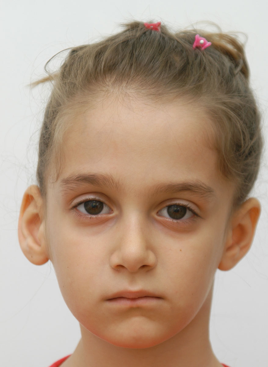 Кривой лоб. Аденоидный Тип лица у детей. Асимметричное лицо у ребенка.