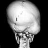 Premature synostosis of lambdoid suture. Three-dimensional display of old technology. Typical occipital bulge