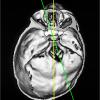 Premature synostosis of lambdoid suture. skull base imaging. Divergence of the axes of the front and rear half of the base