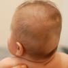 Positional plagiocephaly