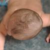 Positional plagiocephaly