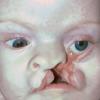 Craniofacial cleft #3