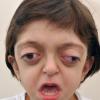 Crouzon syndrome at the age of 5 years
