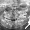 Application of distraction osteogenesis device