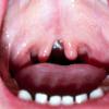 Submucous cleft. Bifid (double) uvula is observed.