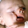 Craniofacial cleft #4