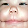 Craniofacial cleft #7