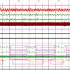 Multiparametric recording. Observe  the interruptions of air flow (the green thin line wave stops) while respiratory attempts remain (green wavy line just below) and the fall of saturation of hemoglobin (thin red line)