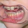 This splint promotes the lower jaw, thus freeing the breath.