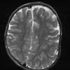 Magnetic resonance imaging. Asymmetry of the cerebral hemispheres