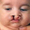 Bilateral cleft lip